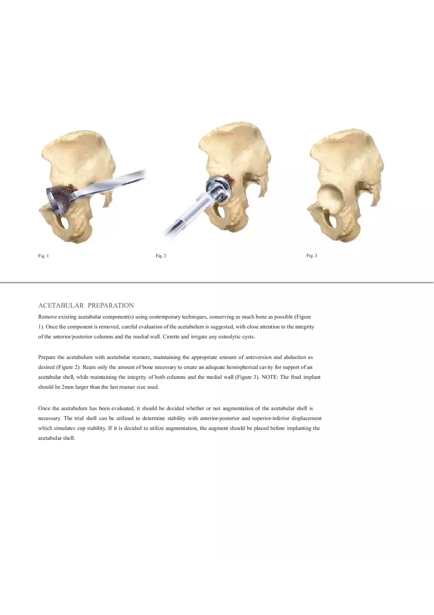 Regenerex Ringloc Surgical Technique - Page 14