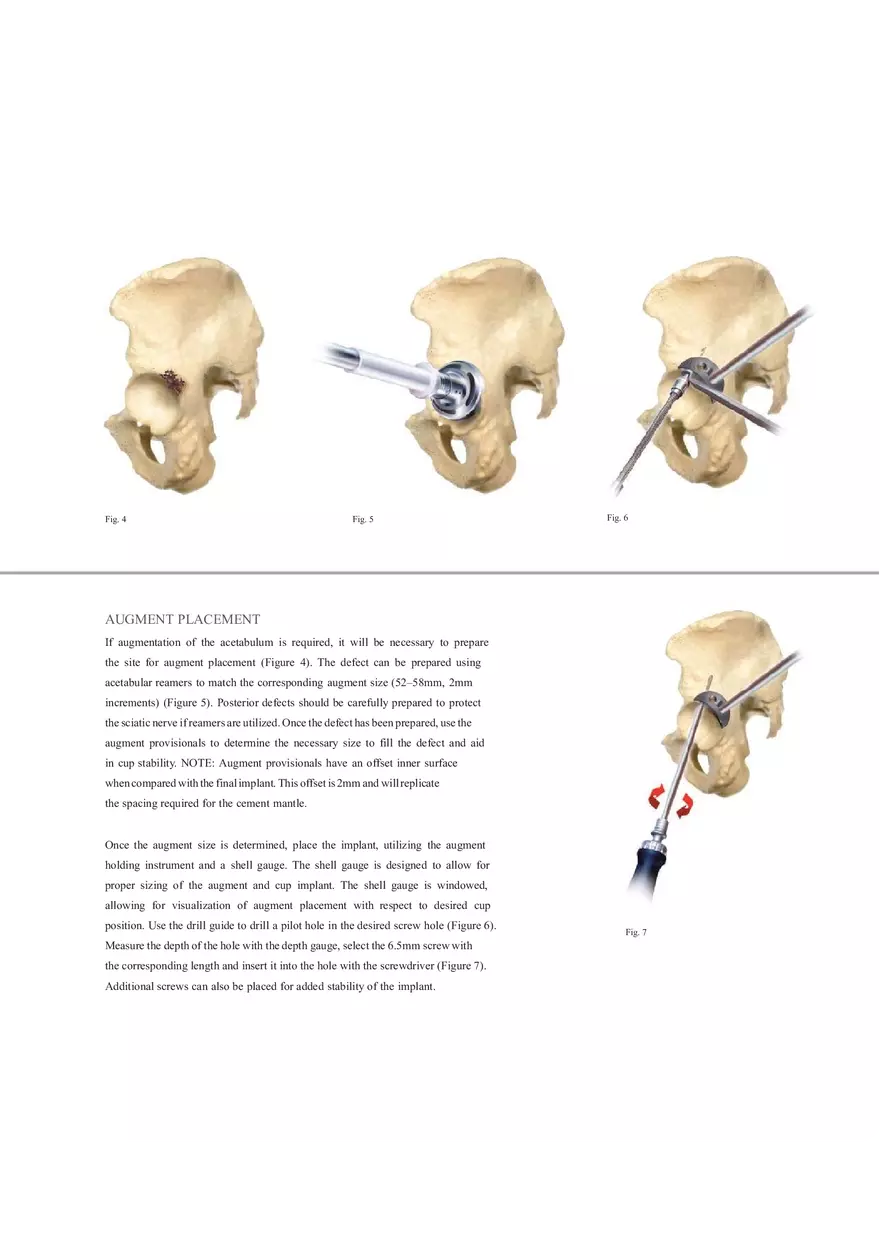 Regenerex Ringloc Surgical Technique - Page 15
