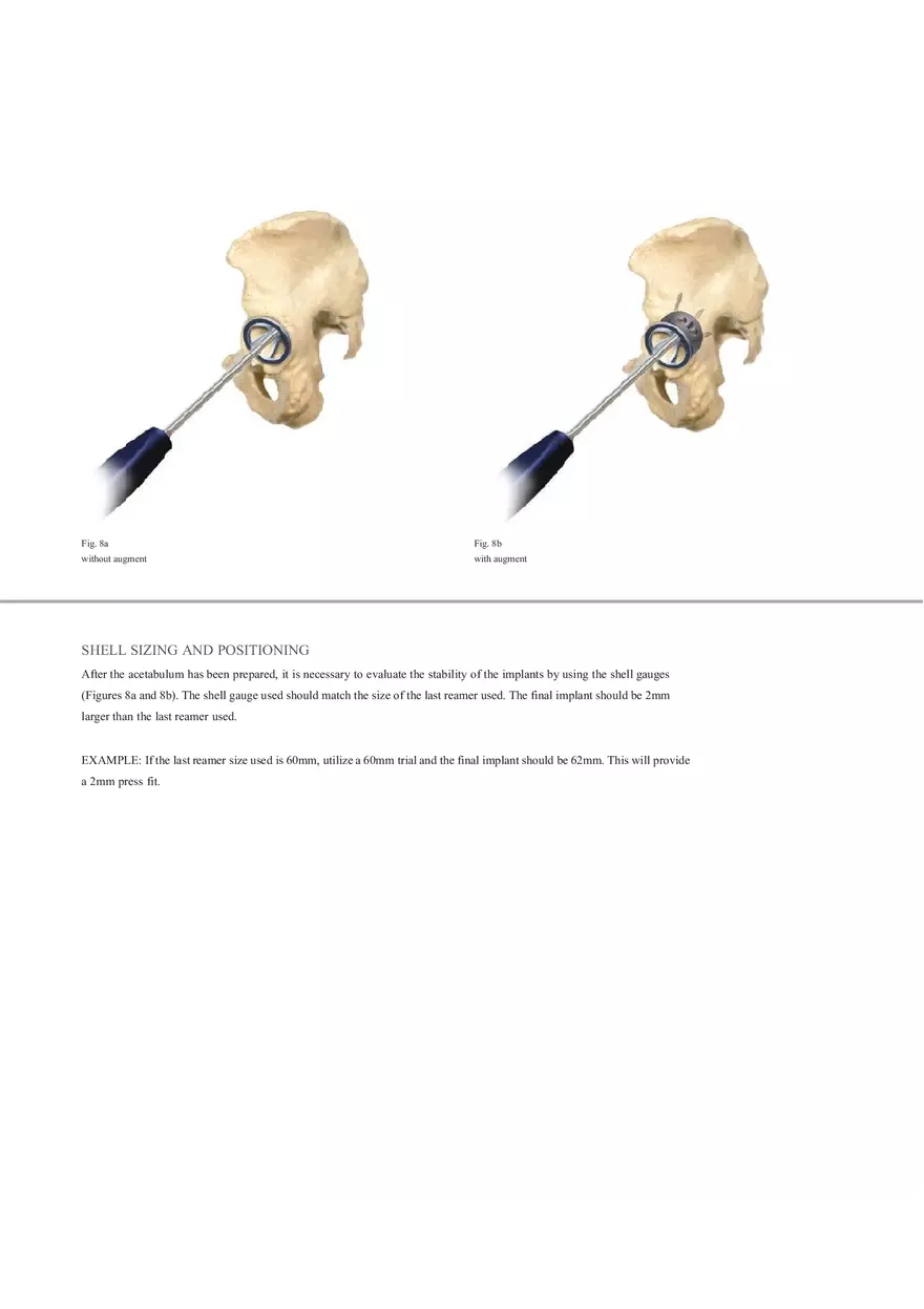 Regenerex Ringloc Surgical Technique - Page 16