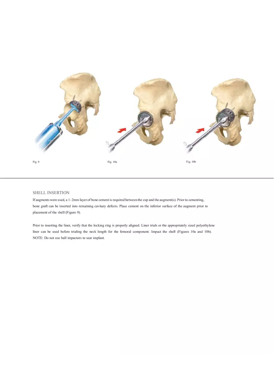 Regenerex Ringloc Surgical Technique - Page 17