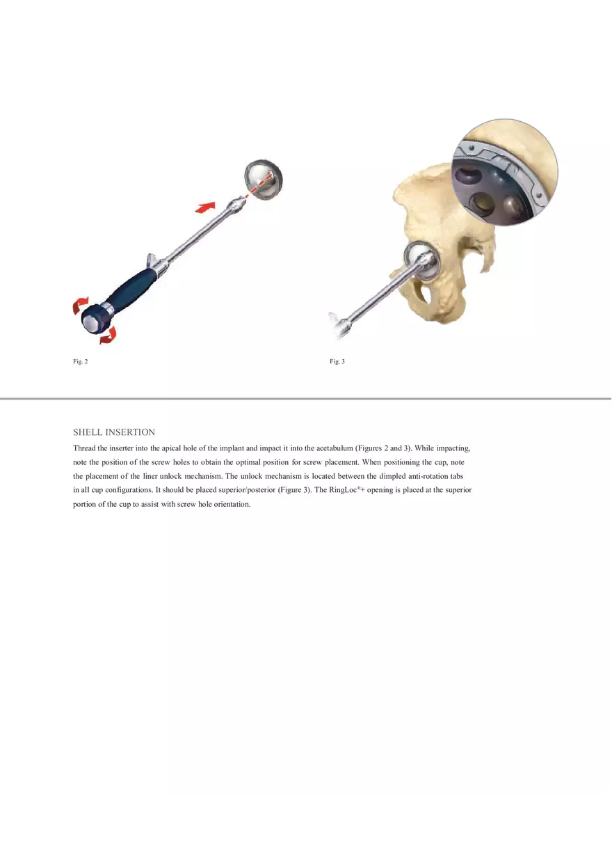 Regenerex Ringloc Surgical Technique - Page 2