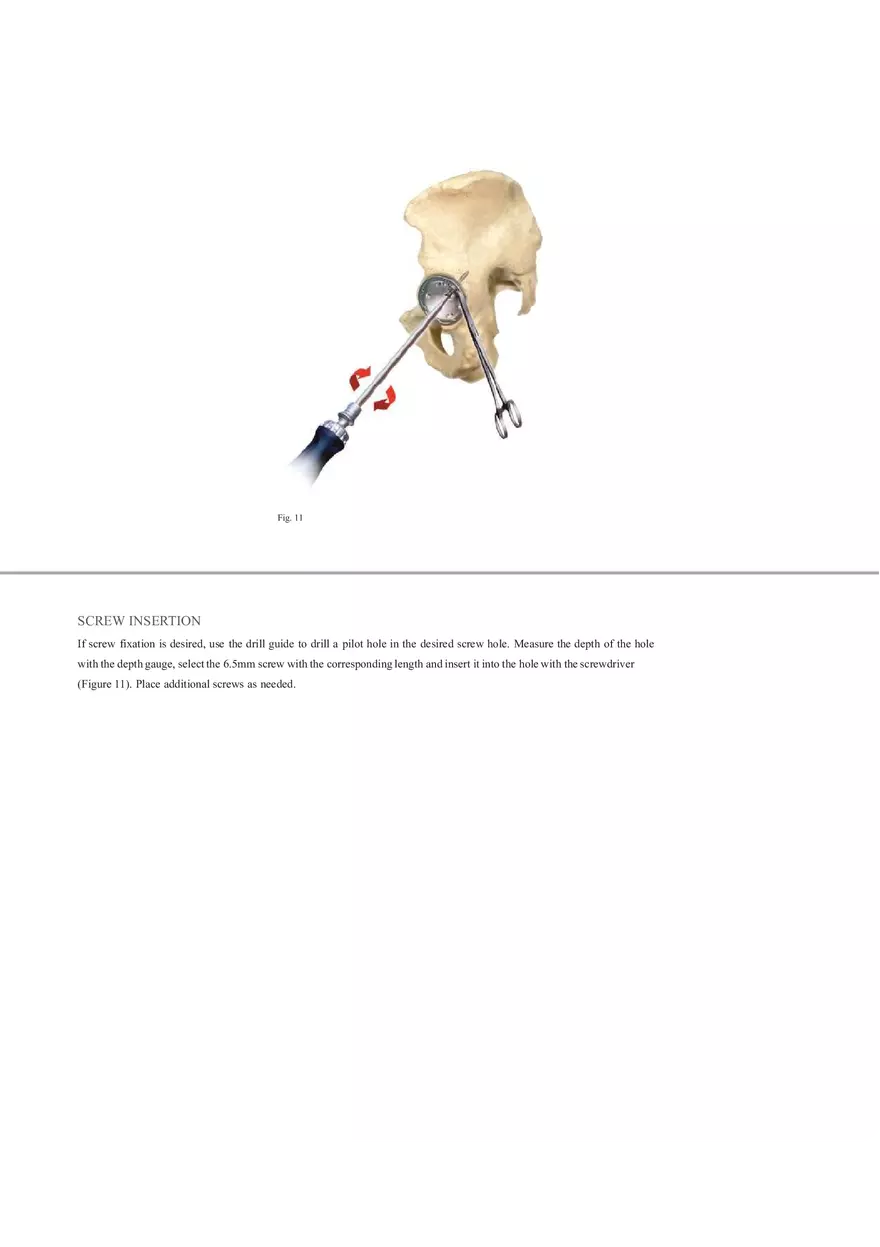 Regenerex Ringloc Surgical Technique - Page 3
