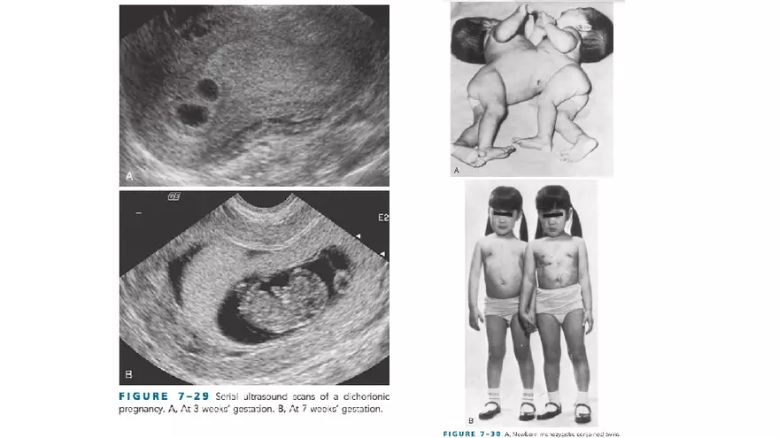 Placenta, Extraembryonic Membranes, and Multiple Pregnancies Part 6 - Page 8