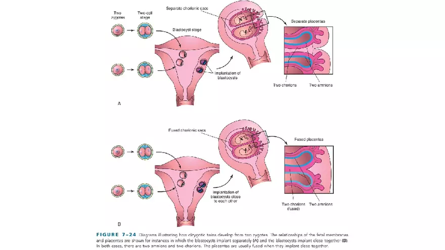 Placenta, Extraembryonic Membranes, and Multiple Pregnancies Part 6 - Page 15
