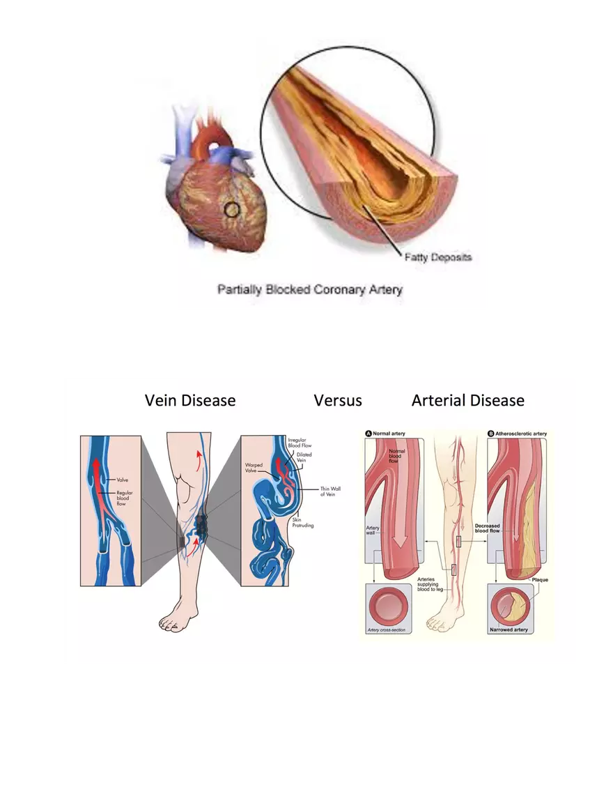 Anemia Atherosclerosis HTN Illustrations - Page 2