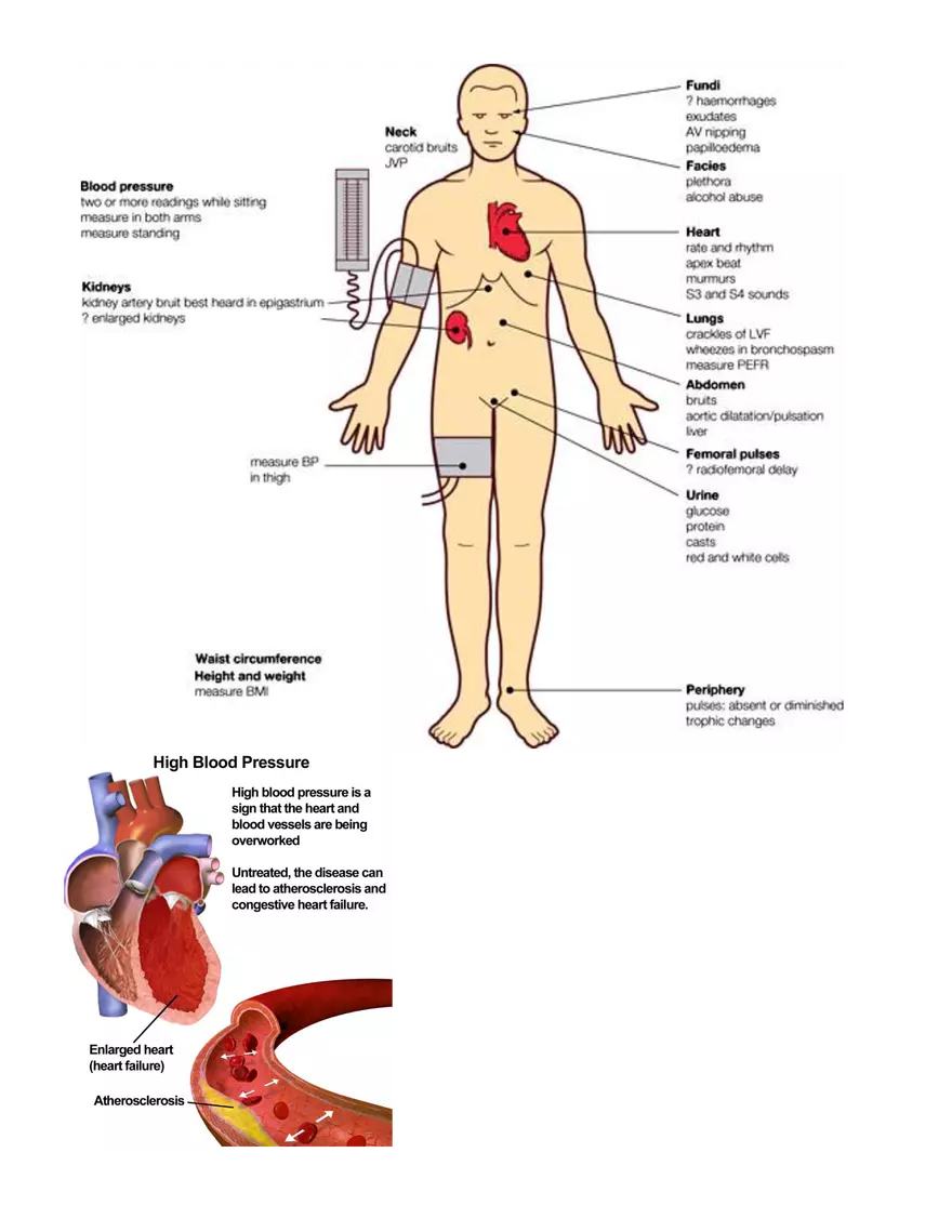 Anemia Atherosclerosis HTN Illustrations - Page 3