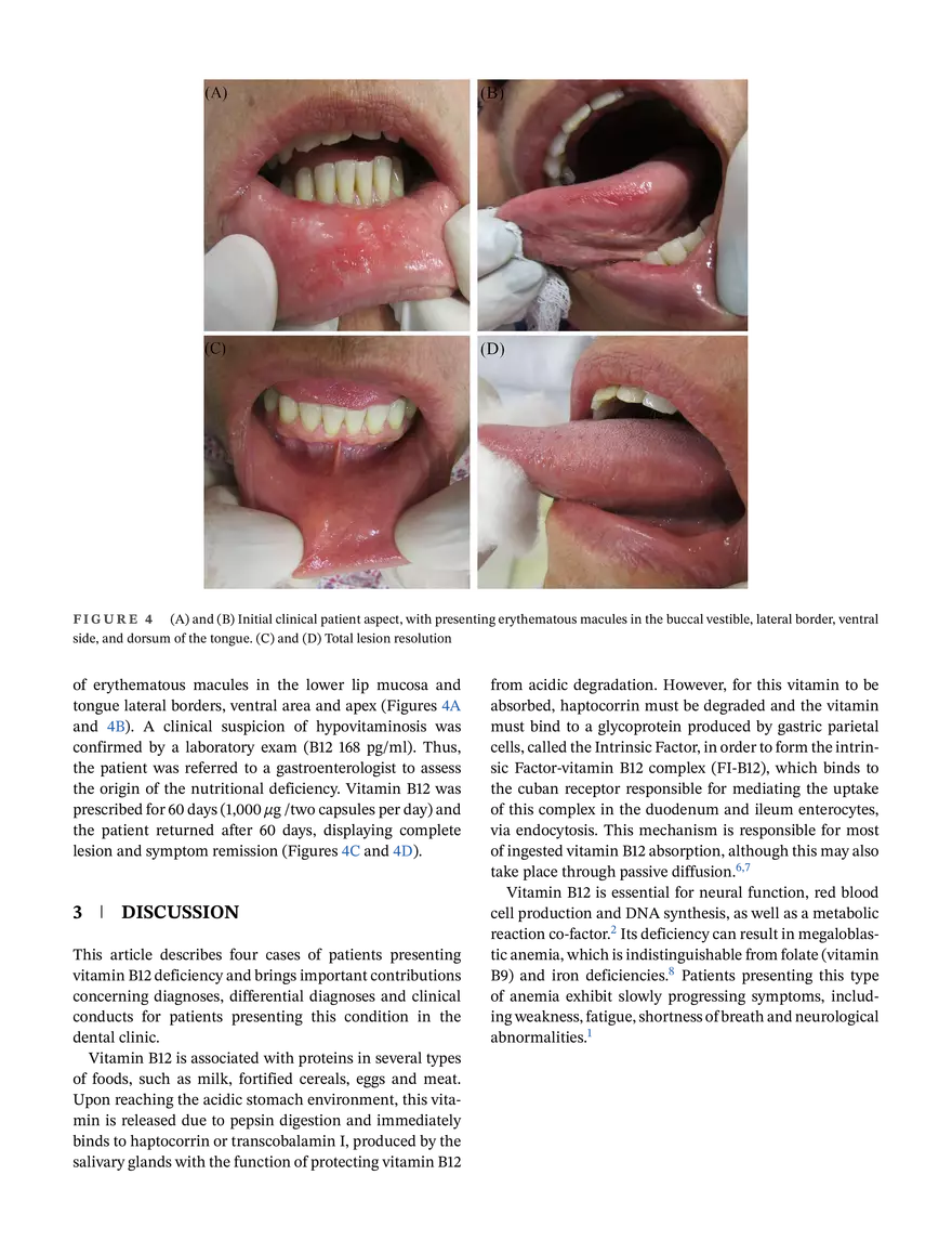 Report of Four Cases With Oral Manifestations - Page 4