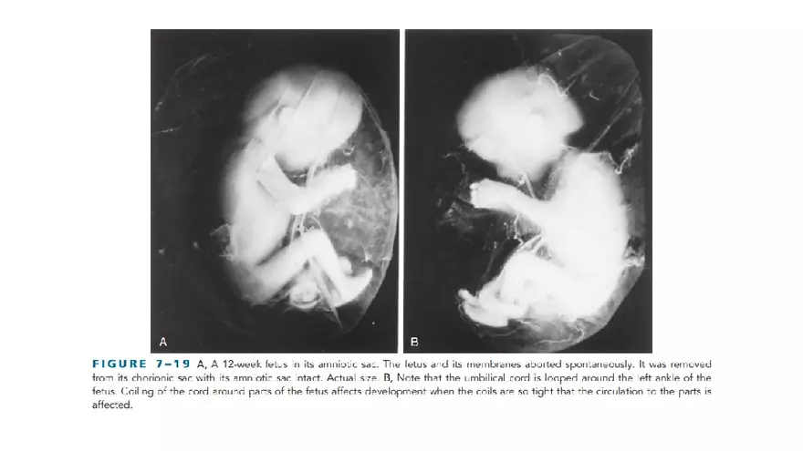 Placenta, Extraembryonic Membranes, and Multiple Pregnancies Part 5 - Page 3