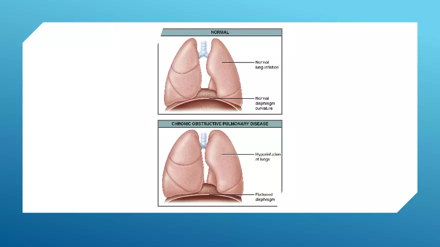 Chronic Obstructive Pulmonary Disease (COPD) Part 2 - Page 3