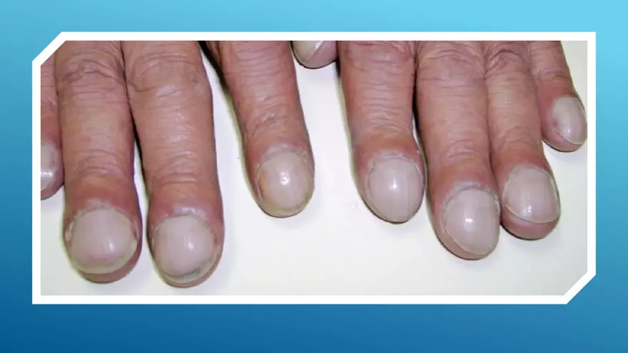 Chronic Obstructive Pulmonary Disease (COPD) Part 2 - Page 5