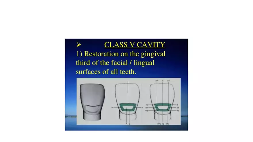 Different Designs of Class V Cavity Preparations - Page 3