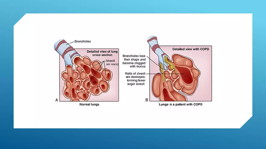 Chronic Obstructive Pulmonary Disease (COPD) Part 1 - Page 7