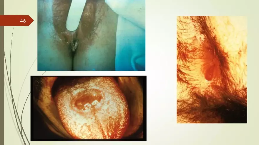 Genital Infection in Gynecology - Page 41