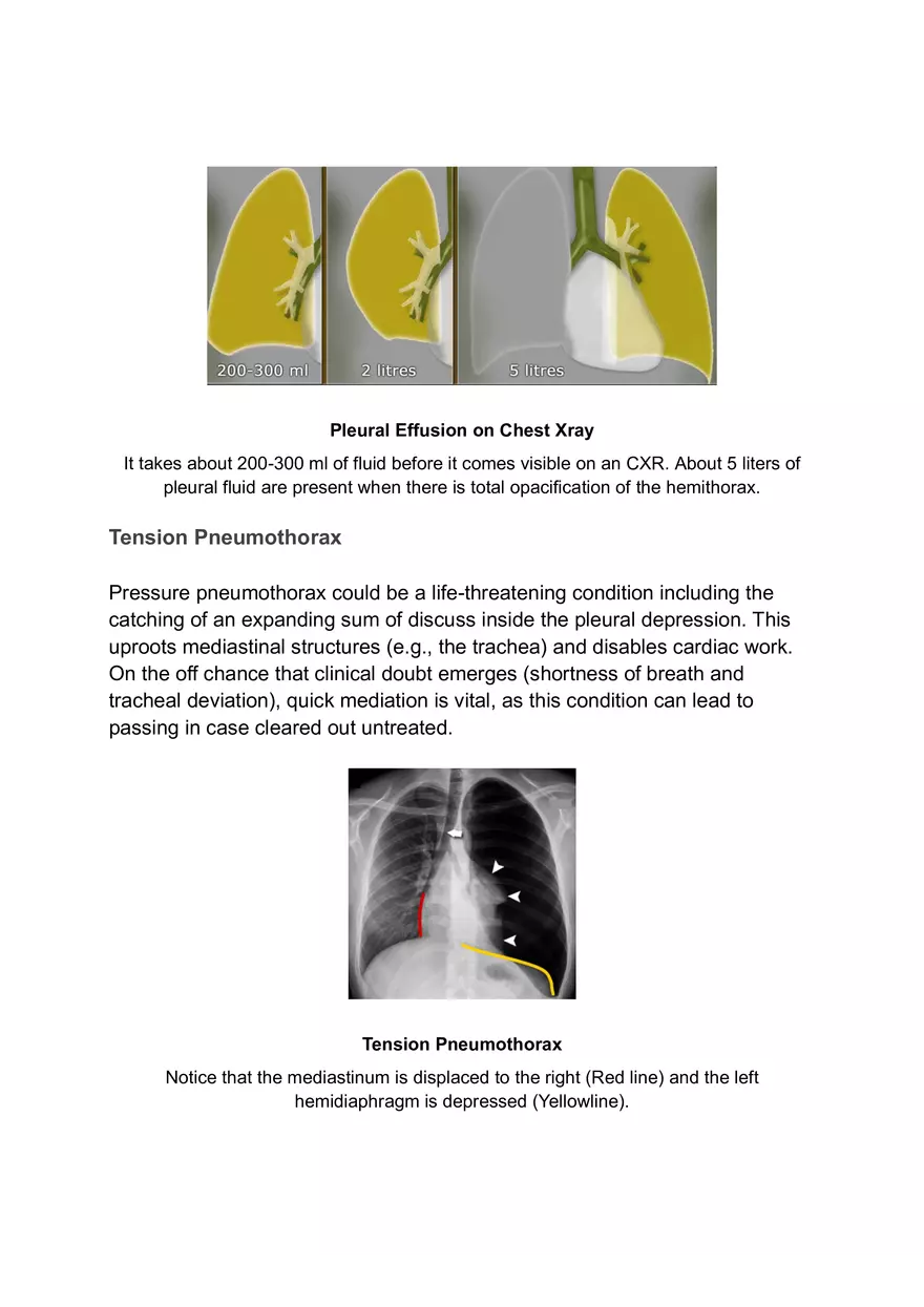ABCDE Approach of Xray Interpretation - Page 11