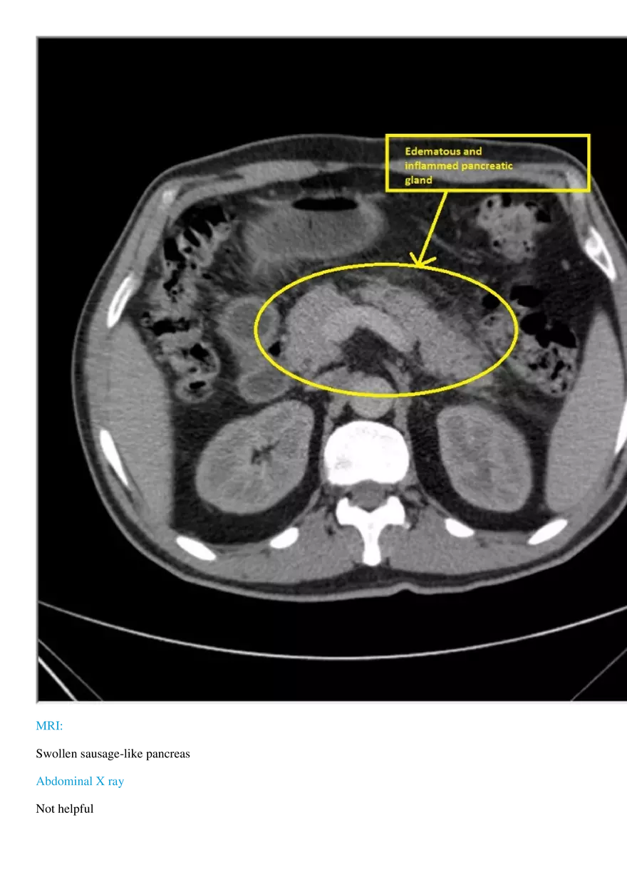 Acute Pancreatitis - Page 6