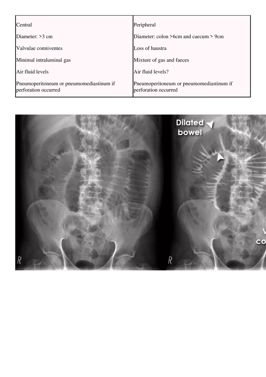 Bowel Obstruction - Page 4