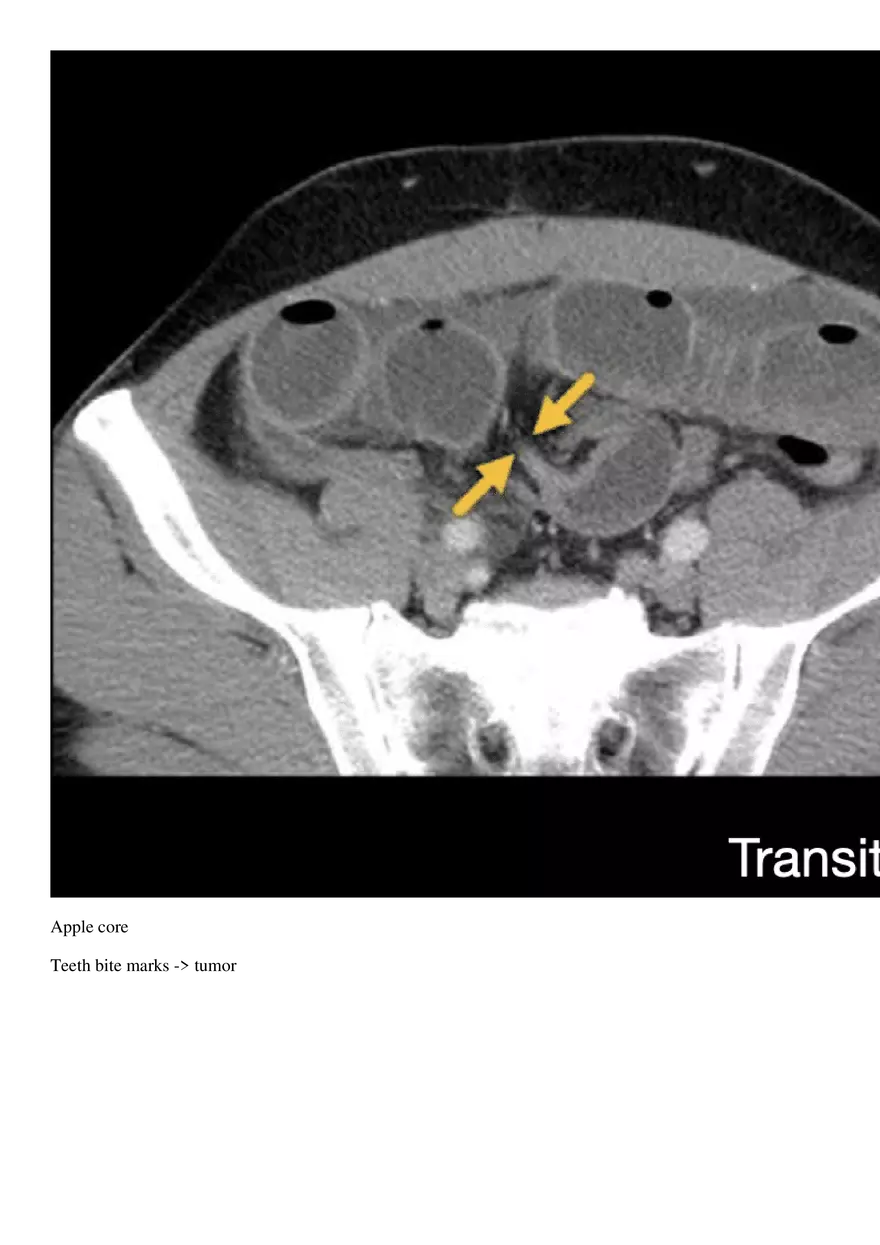Bowel Obstruction - Page 6