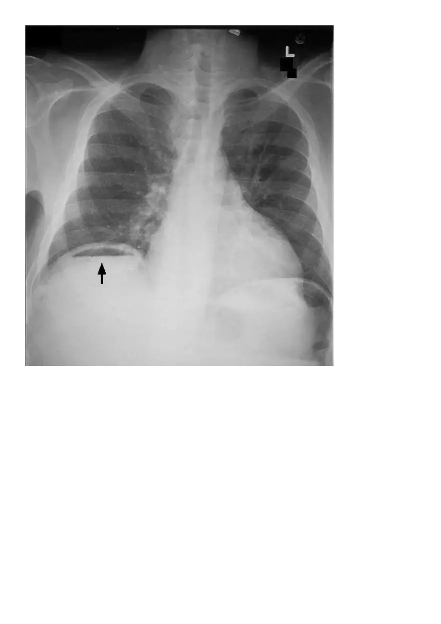 GI Perforation - Page 4
