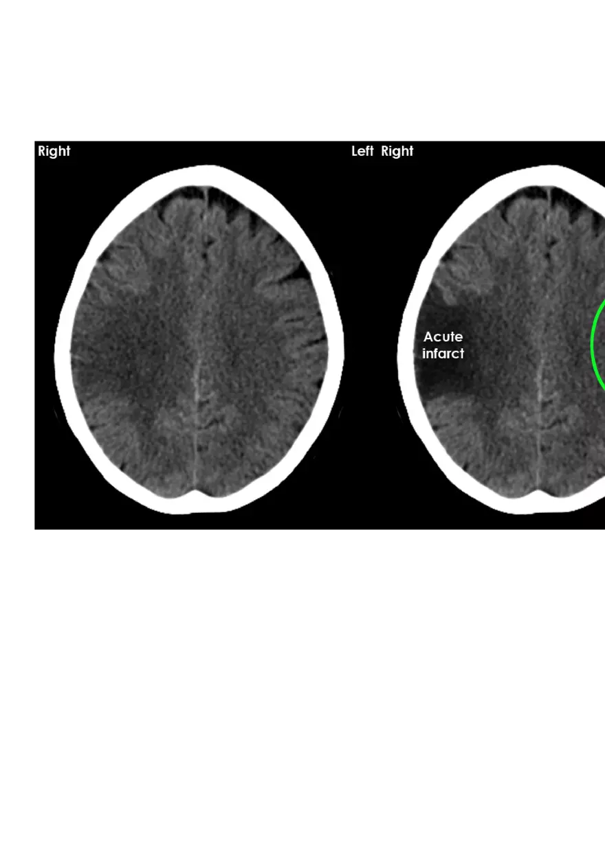Ischemic Stroke and Transient Ischaemic Attack - Page 10