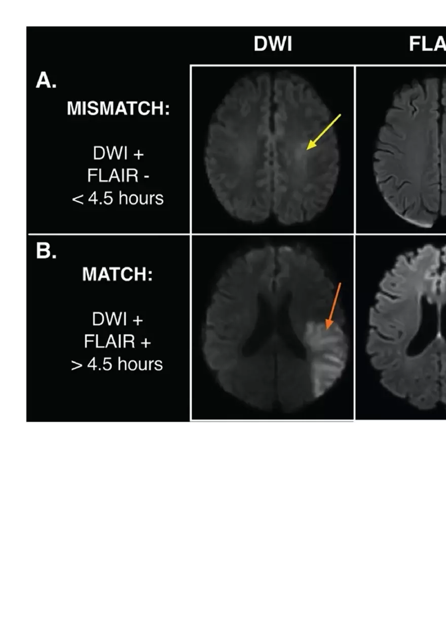 Ischemic Stroke and Transient Ischaemic Attack - Page 12