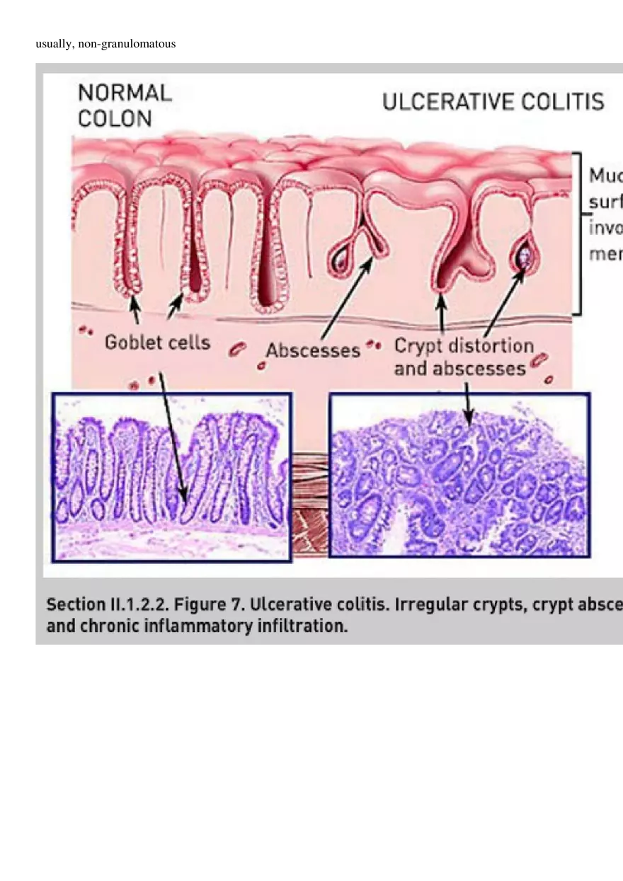 Ulcerative Colitis - Page 4