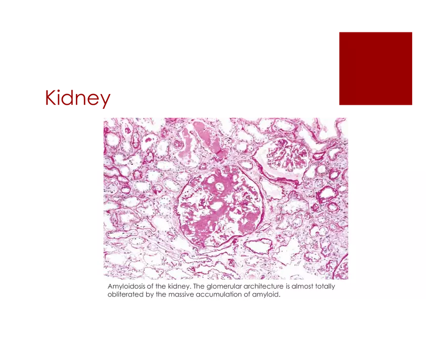 Amyloid Neuropathy Lecture Part 1 - Page 9
