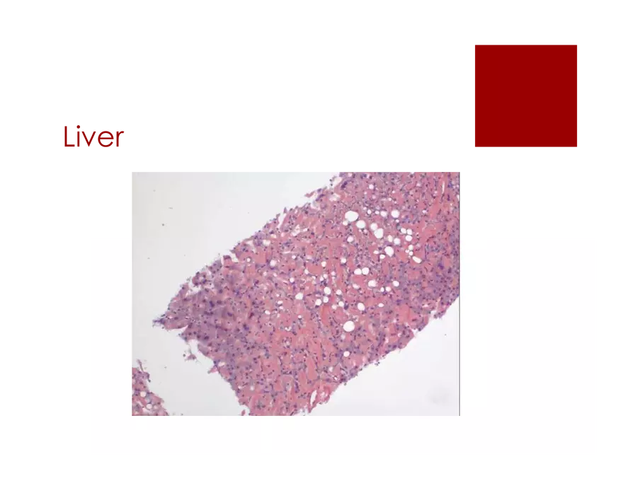 Amyloid Neuropathy Lecture Part 1 - Page 10