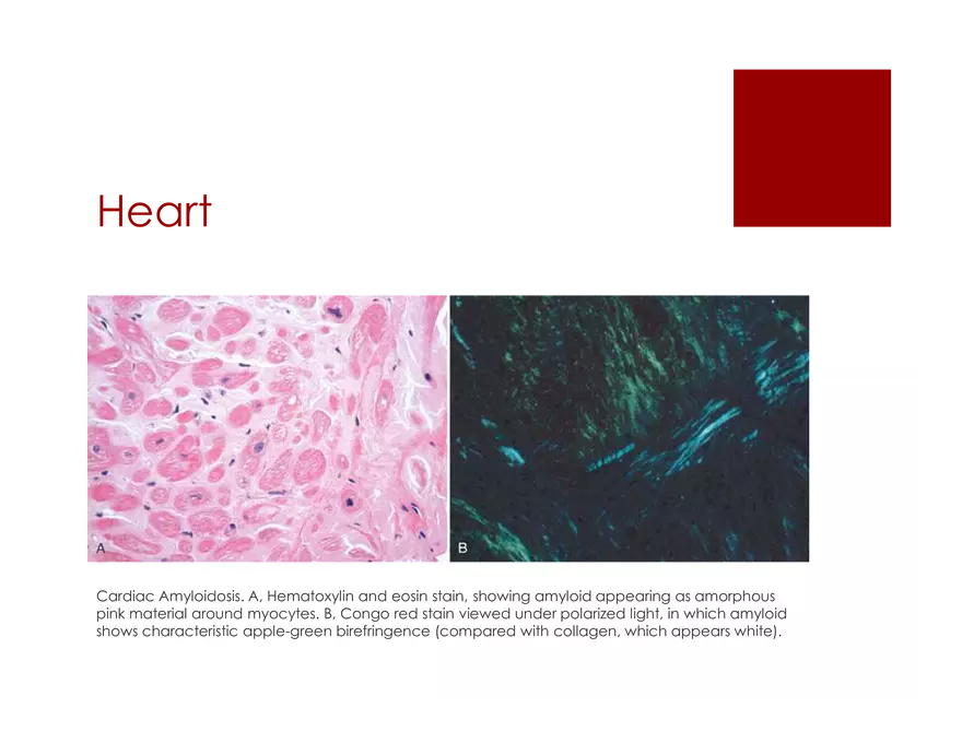 Amyloid Neuropathy Lecture Part 1 - Page 11