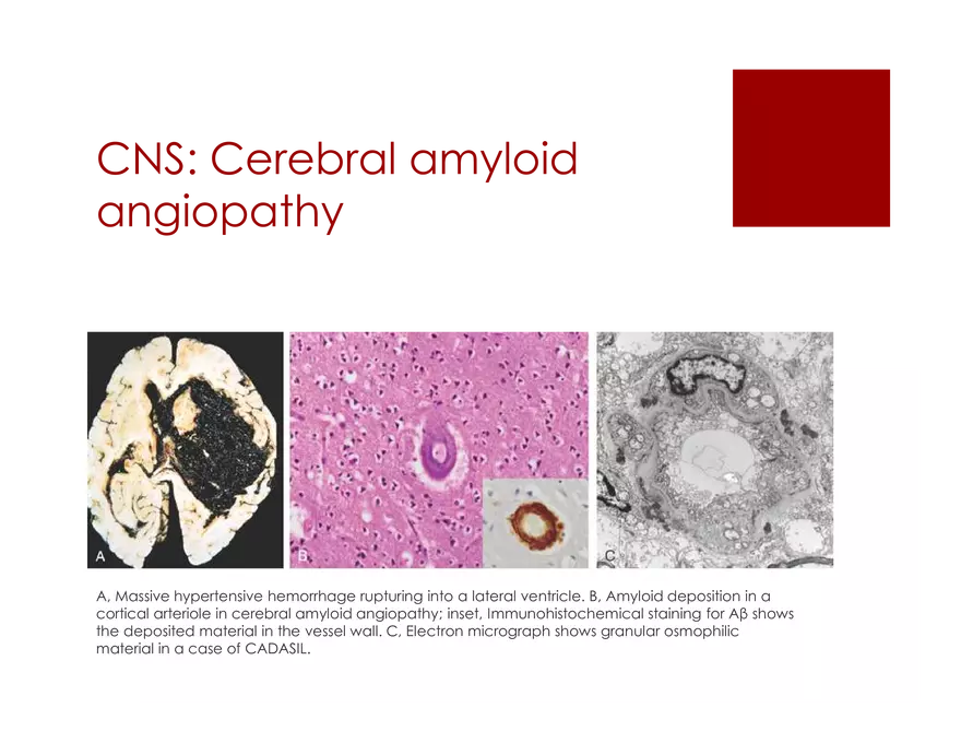 Amyloid Neuropathy Lecture Part 1 - Page 12