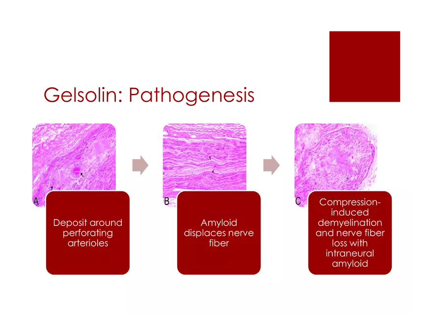 Amyloid Neuropathy Lecture Part 3 - Page 3