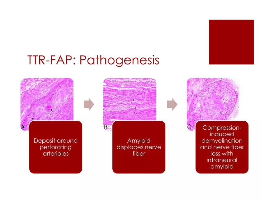 Amyloid Neuropathy Lecture Part 2 - Page 17