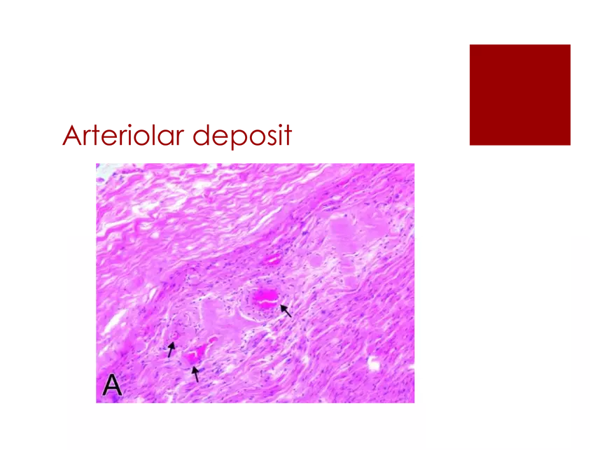 Amyloid Neuropathy Lecture Part 2 - Page 18