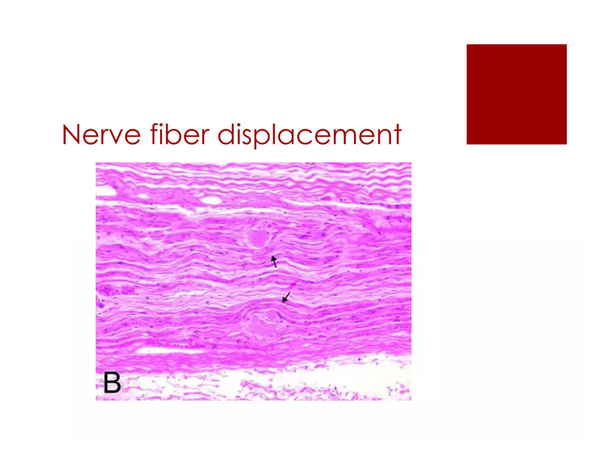 Amyloid Neuropathy Lecture Part 2 - Page 19