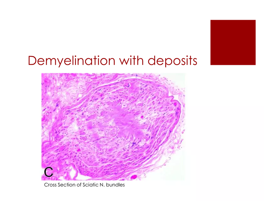 Amyloid Neuropathy Lecture Part 2 - Page 20