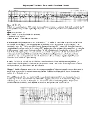 Polymorphic Ventricular Tachycardia (Torsadede Pointes)