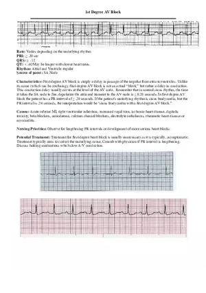 1st Degree AV Block
