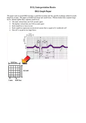 Premature Atrial Contractions (PACs)
