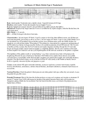 2nd Degree AV Block (Mobitz Type I, Wenckebach)