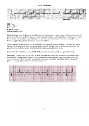 Basic EKG Rhythm Analysis Guide