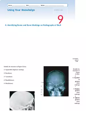 Identifying Bones and Bone Markings on Radiographs of Skull