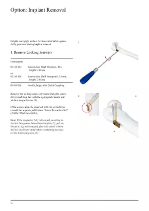 Femoral Neck Checking Option Implant Removal