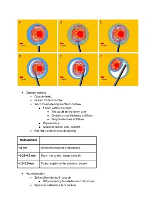 IOL Implant