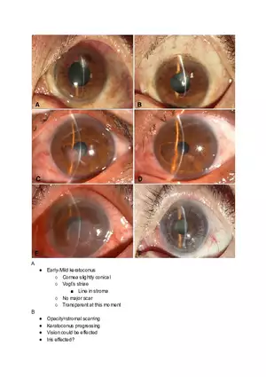 First and Second Keratoconus Stages