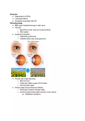 Glaucoma Study Notes